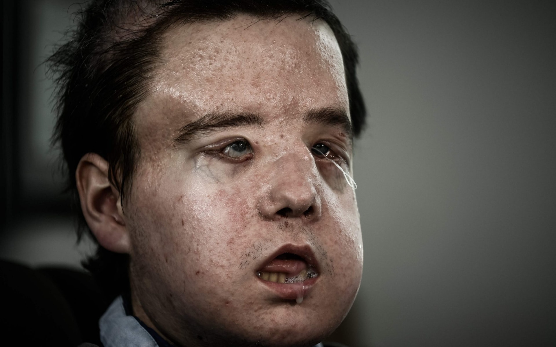 Jerome Hamon is the first man in the world to undergo two face transplants after the first was rejected