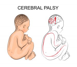 Nurses and Midwifery Council to train nurses on cerebral palsy