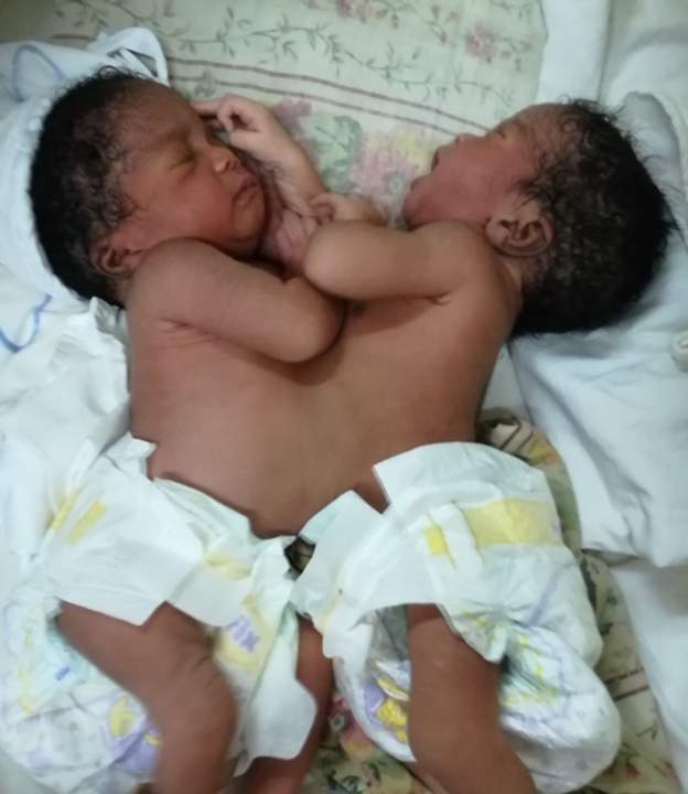 Joy as Nigeria doctors separate conjoined twins