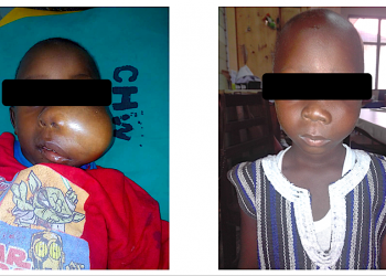 Photo: A child with Burkitt Lymphoma, a common blood cancer in Ghana – Before and After Treatment. He was treated with cheap anti-cancer medicines over a period of 8 months. The overall cost of treatment was less than a tenth of the cost of treating breast cancer. Breast cancer treatment is covered by NHIS but Burkitt Lymphoma is not covered.